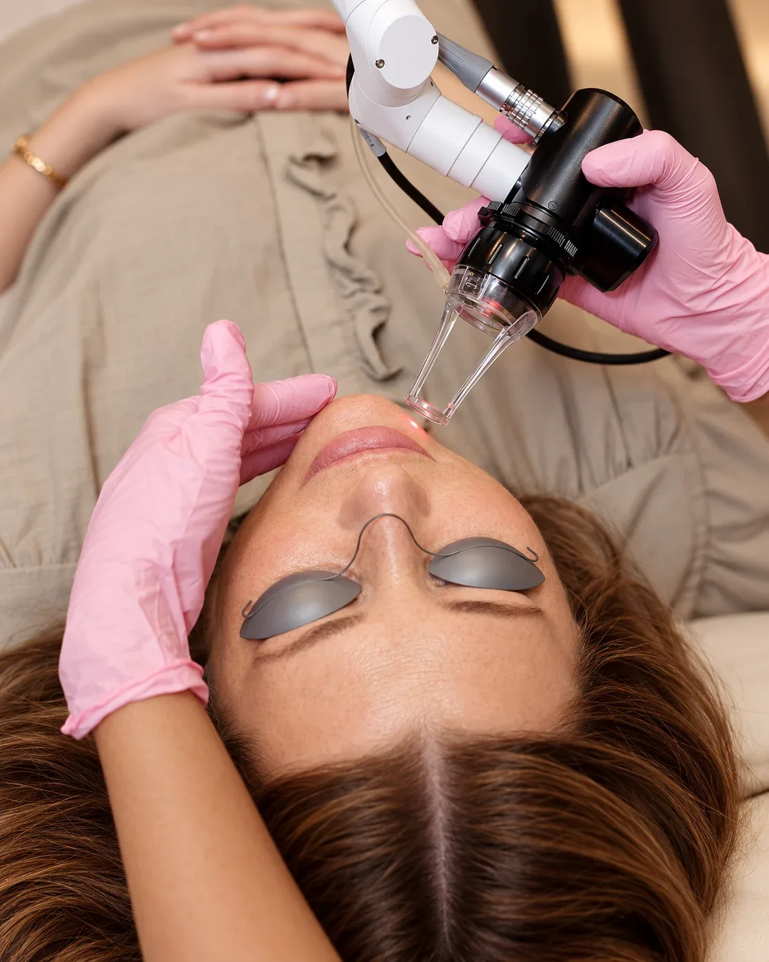 CO2 laser handpiece at the cheek during resurfacing with protective eye shields and pink-gloved hands